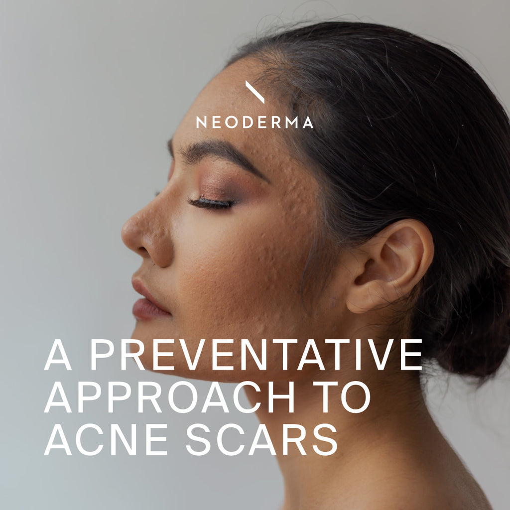 A preventative Approach to Acne Scars