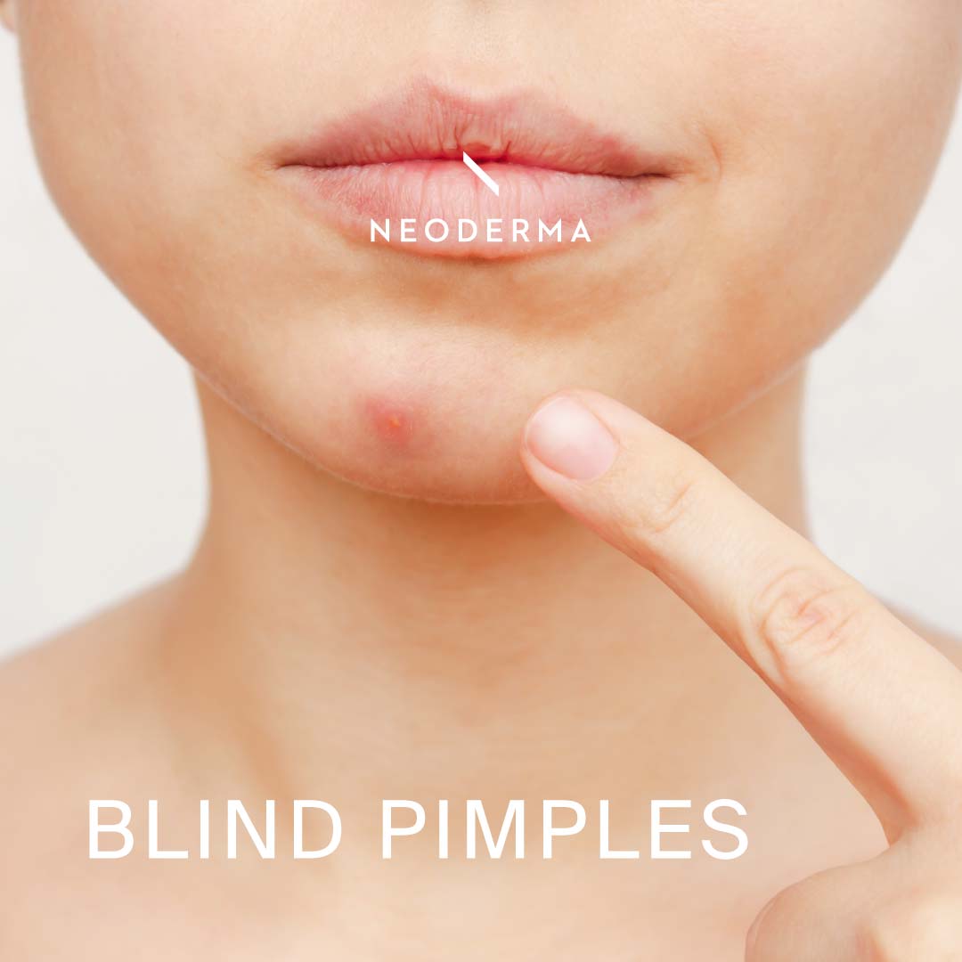 blind-pimples-neoderma