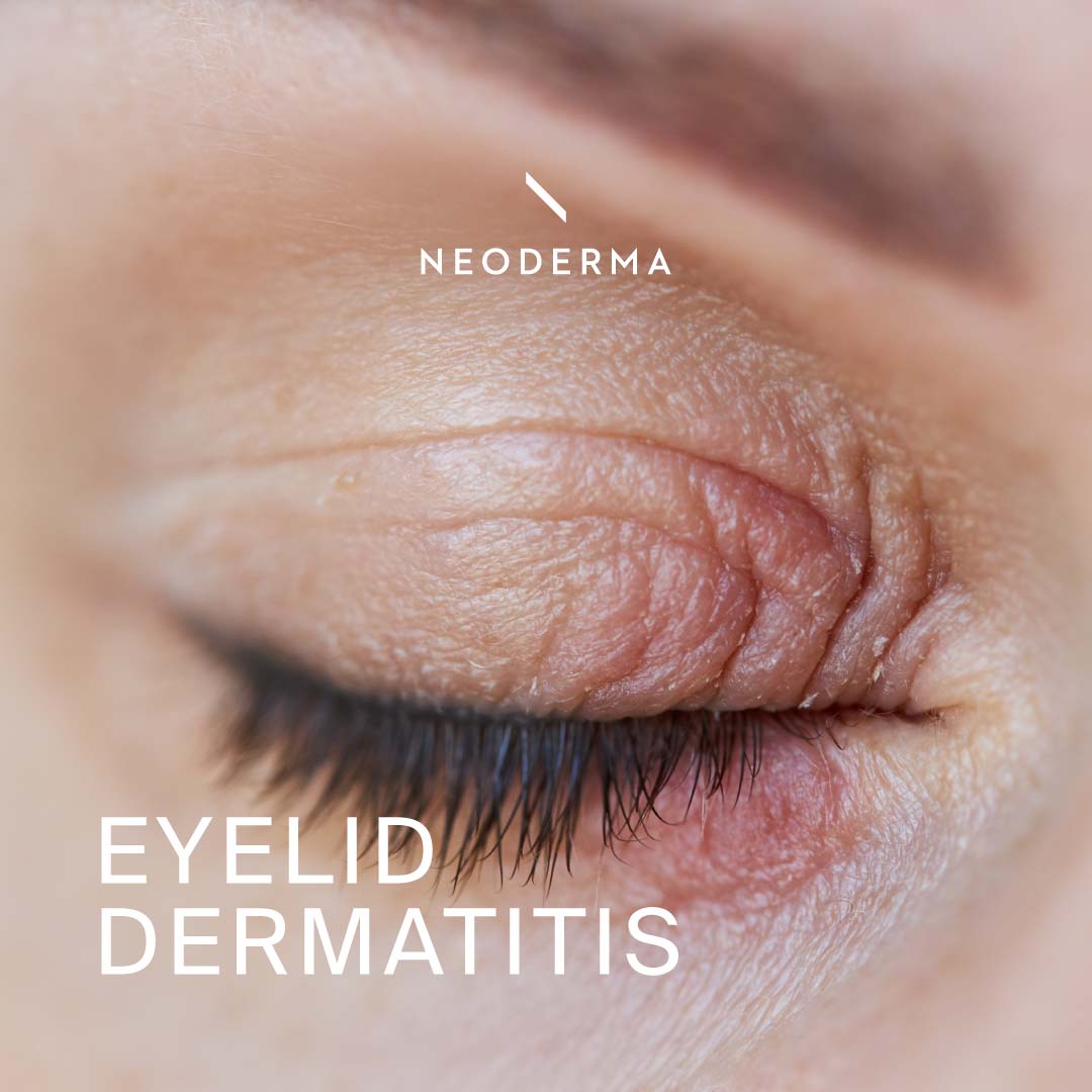 Eyelid Dermatitis NEODERMA Eyelid Dermatitis NEODERMA