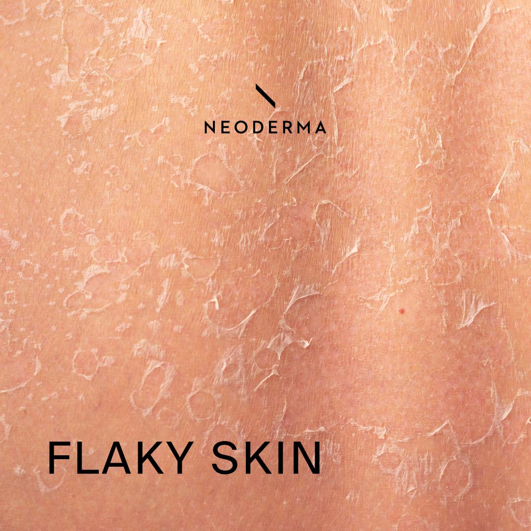 flaky-skin-after-waxing-dry-flaky-skin-side-of-nose-neoderma