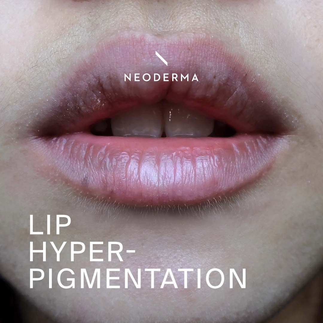 Lip Hyperpigmentation NEODERMA