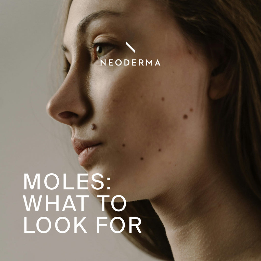 Moles: What to Look for