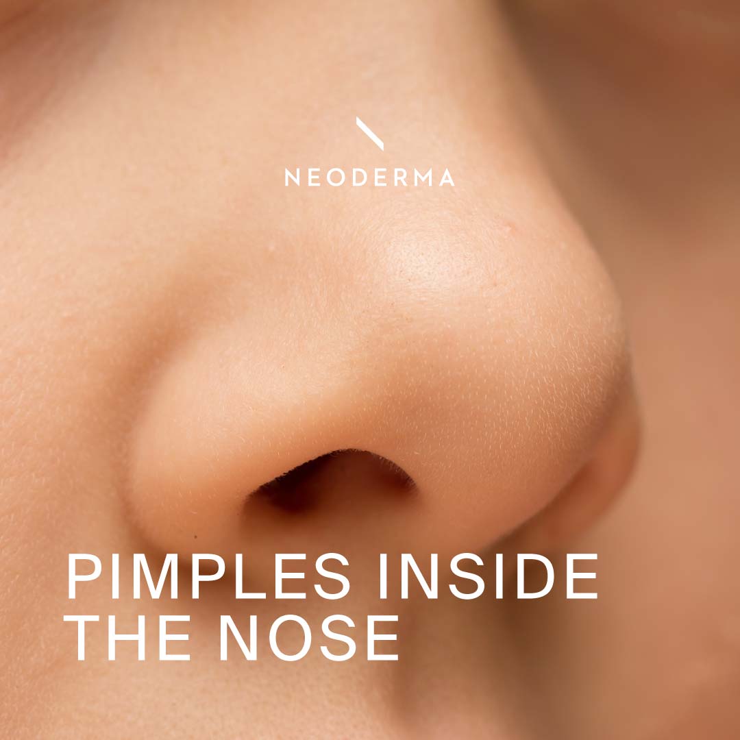 pimples-inside-the-nose-neoderma