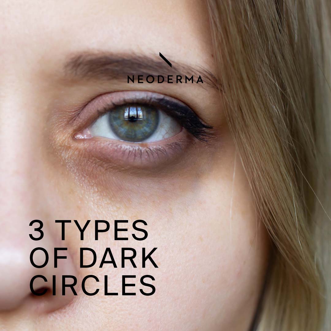 3 Types of Dark Circles