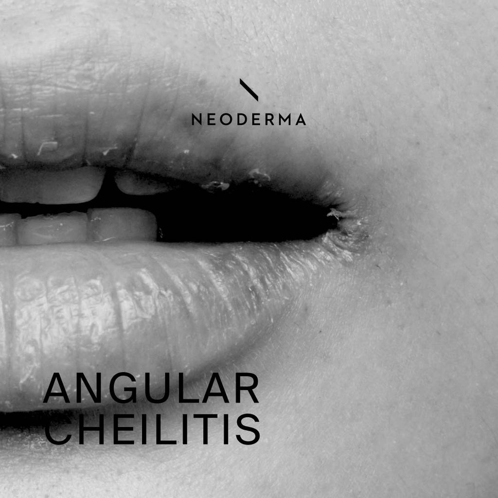 Angular Cheilitis