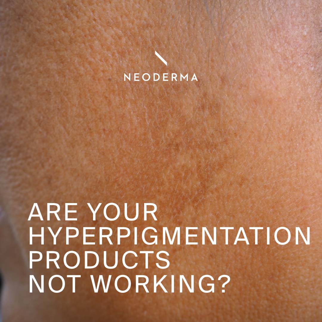 Are Your Hyperpigmentation Products not Working?