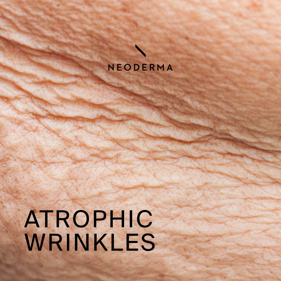 Atrophic Wrinkles