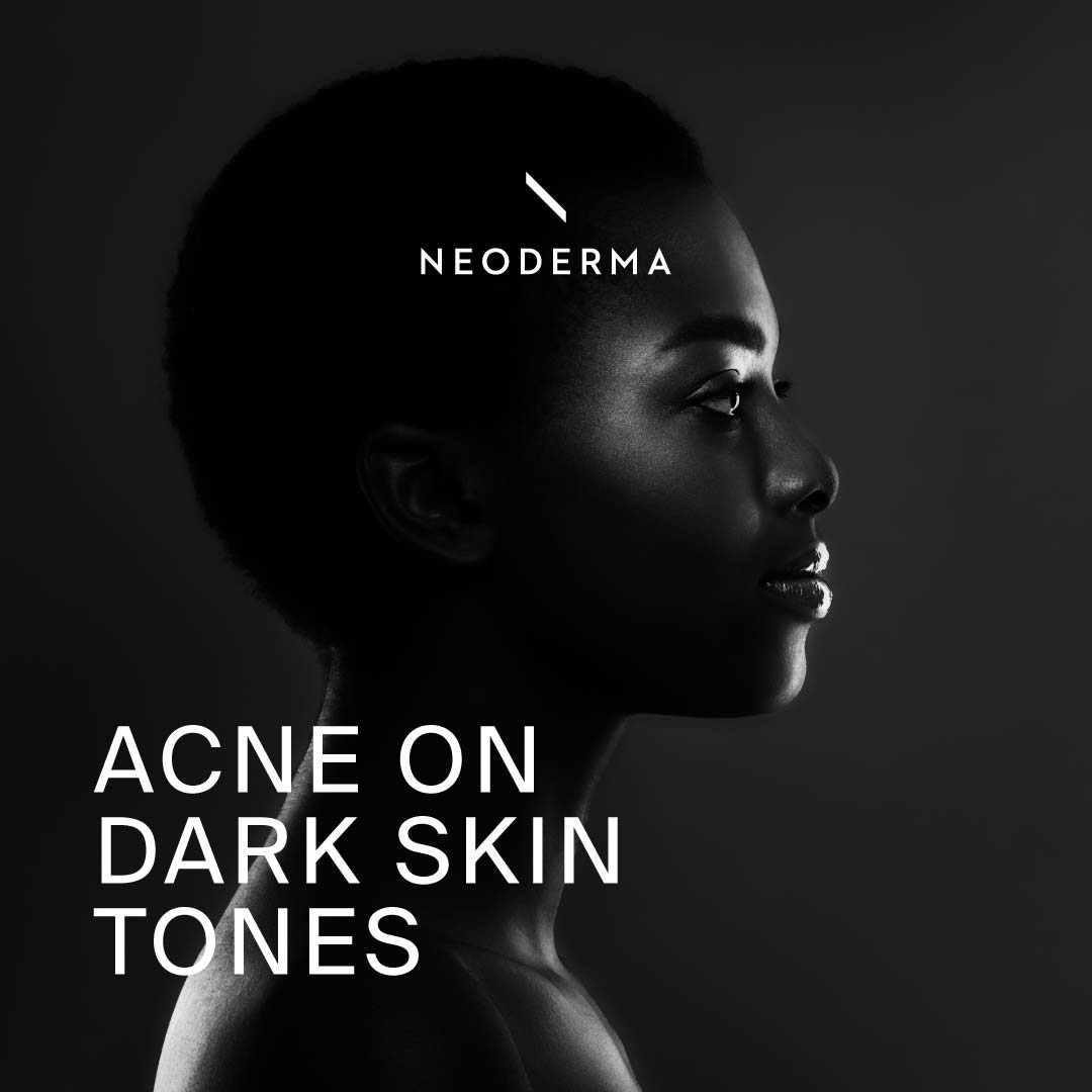 Acne On Dark Skin Tones