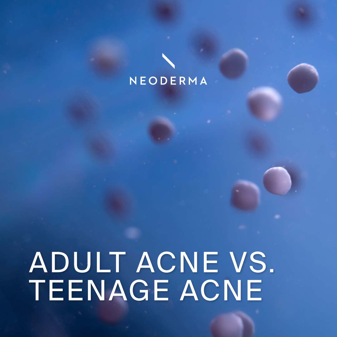 Adult Acne Vs. Teenage Acne