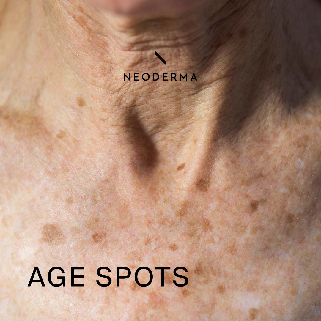 Age Spots