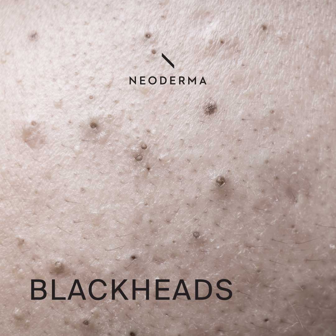 Blackheads