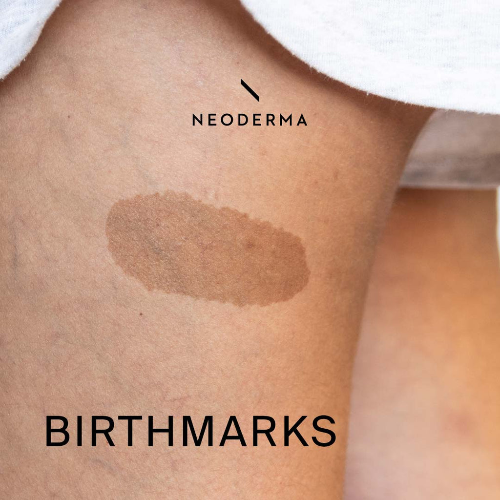 Birthmarks