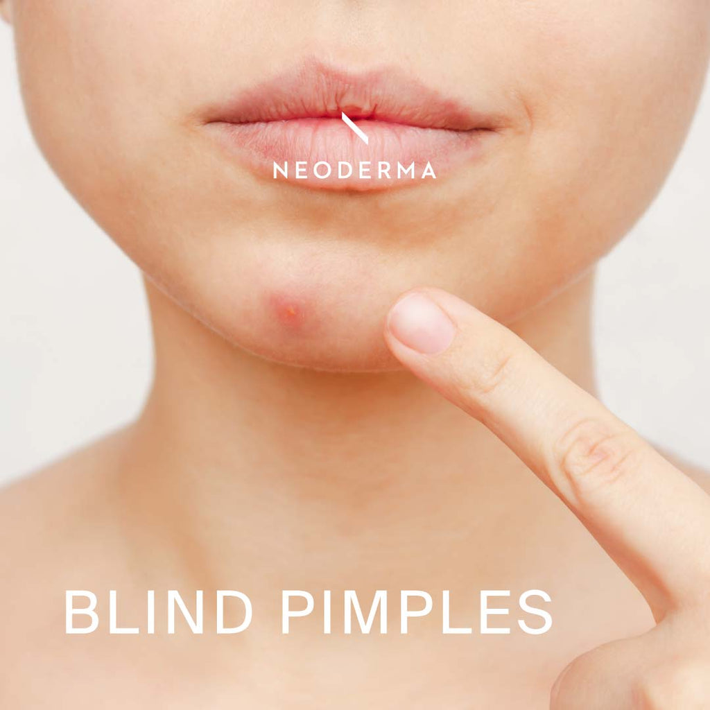 Blind Pimples