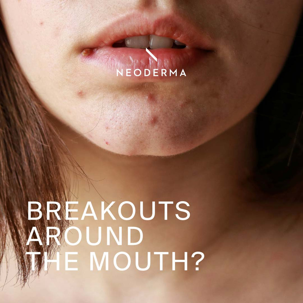 Breakouts Around the Mouth