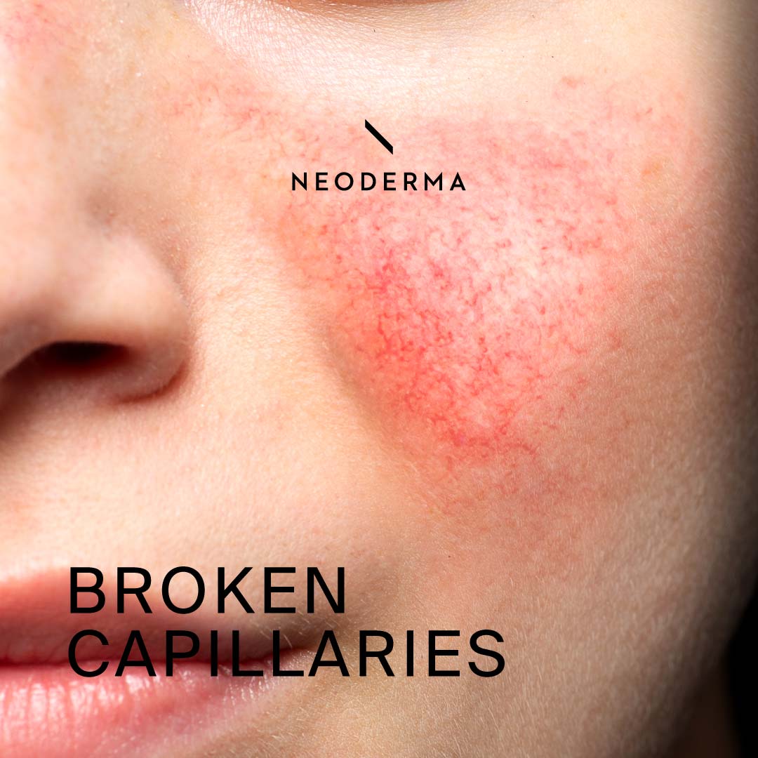 Broken Capillaries