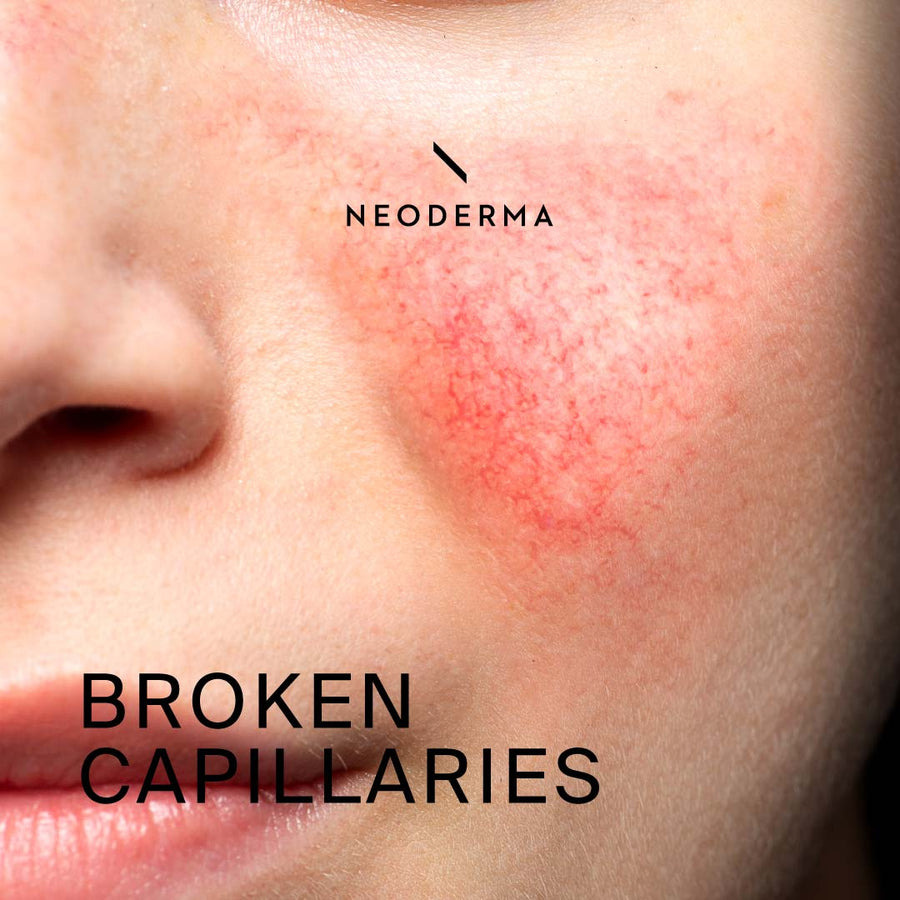 Broken Capillaries