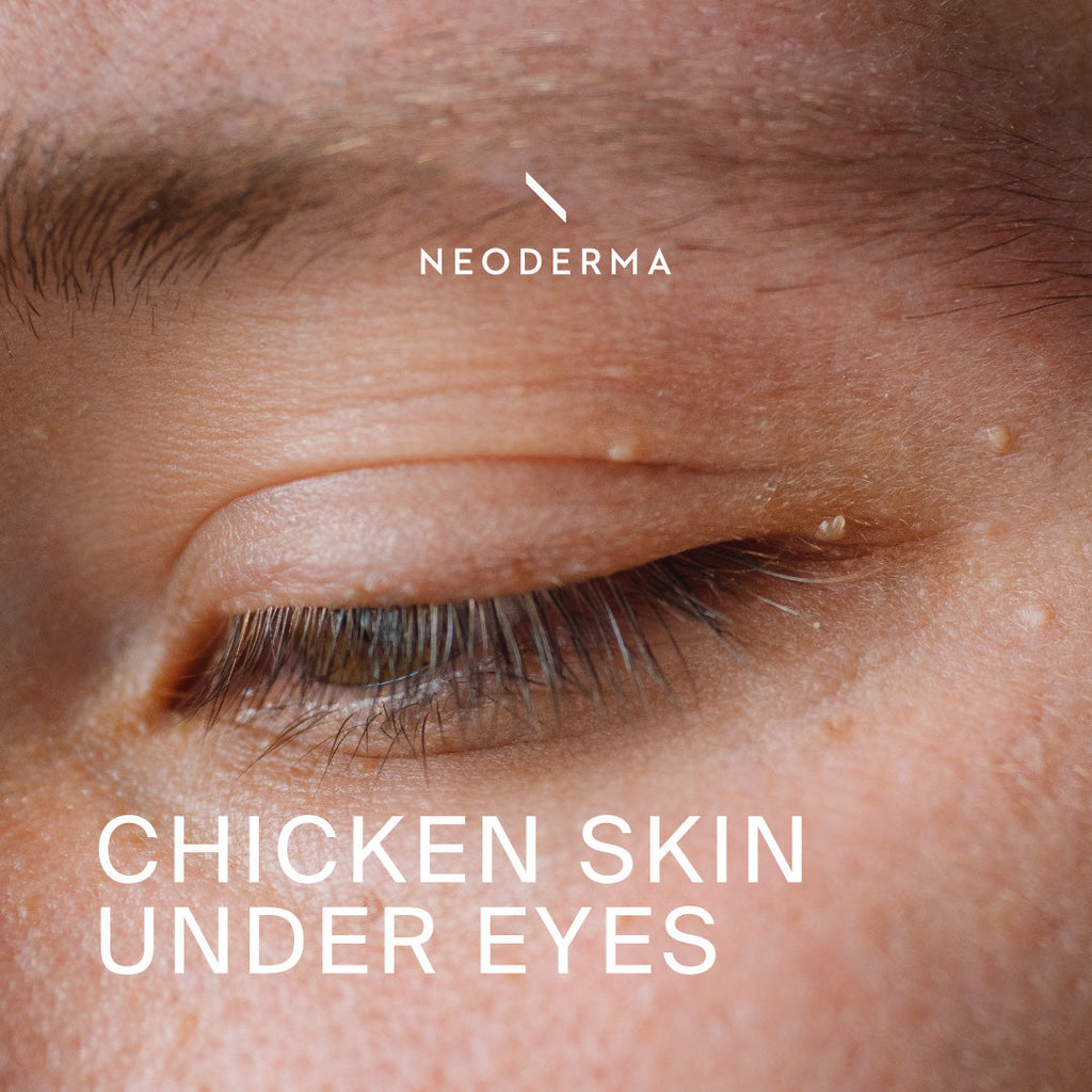 Chicken Skin Under Eyes