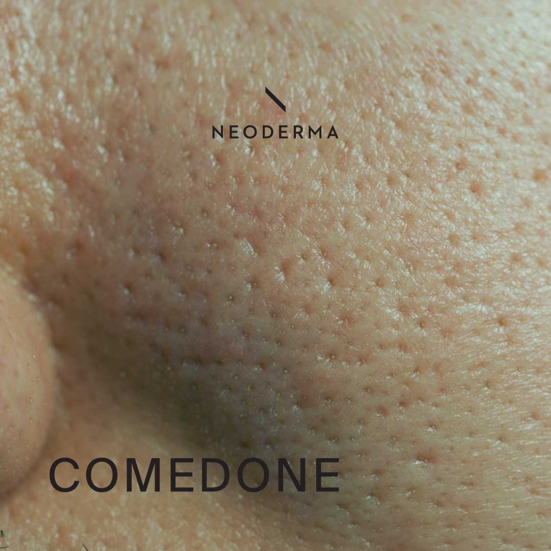 Comedone