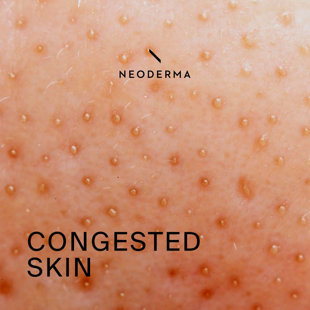 Congested Skin