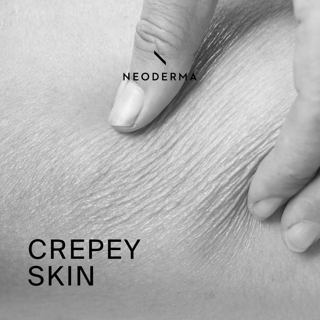 Crepey skin