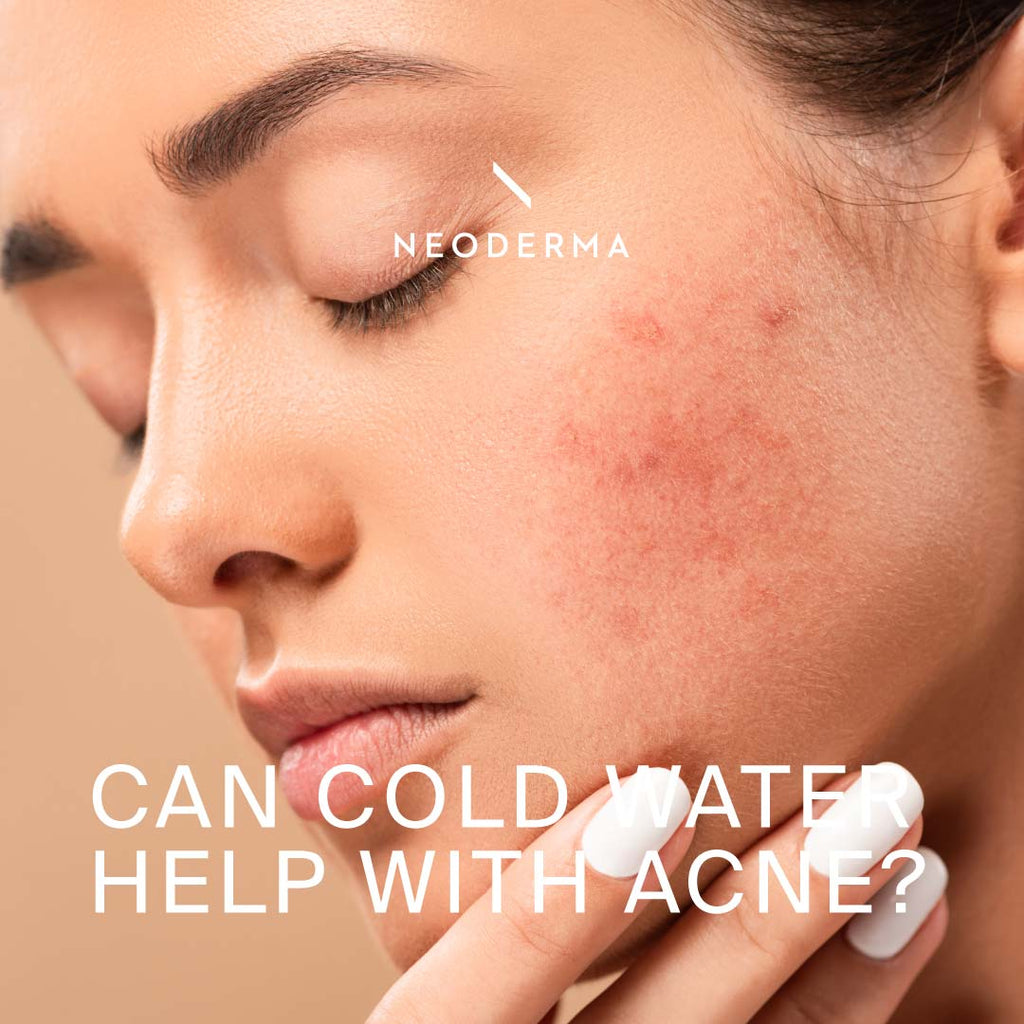 Can Cold Water Help With Acne?