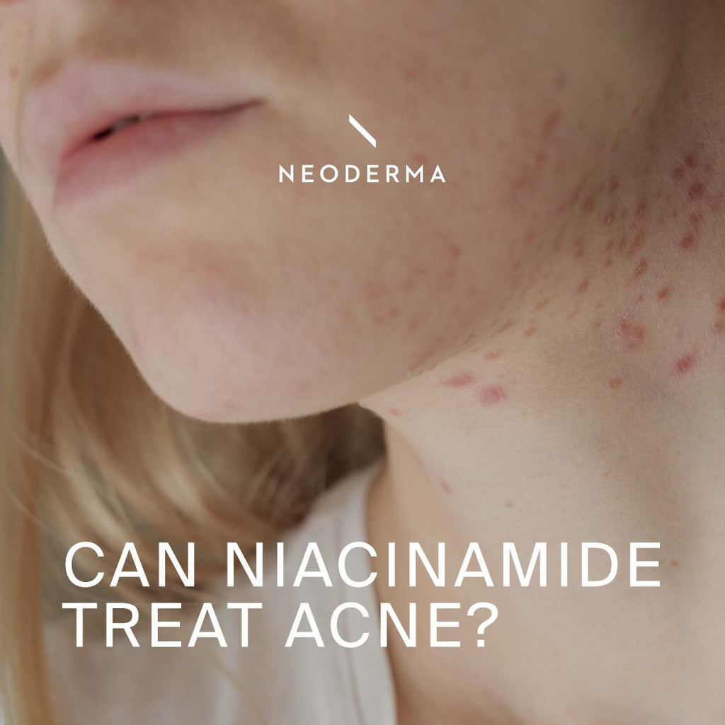Can Niacinamide Treat Acne?
