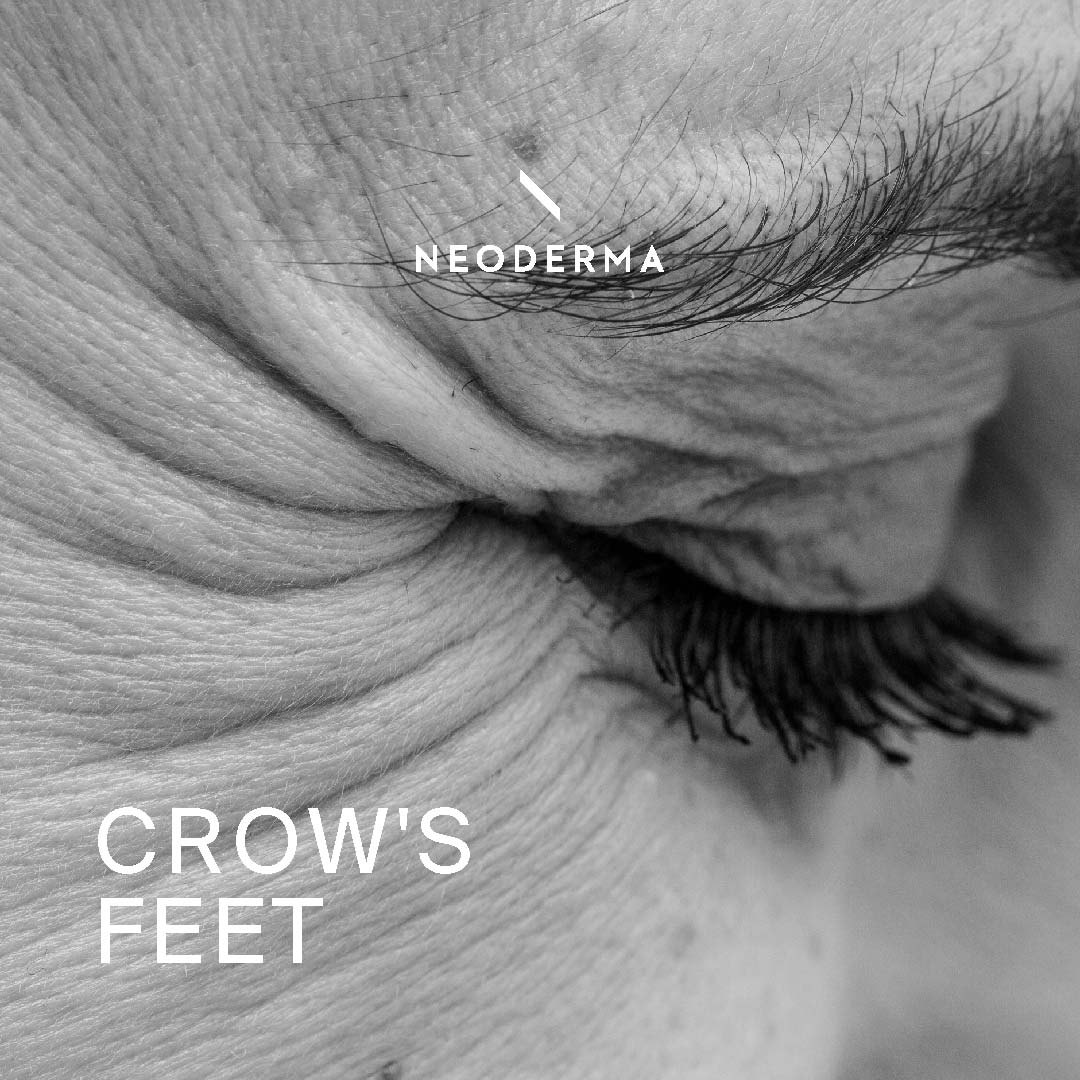 Crow's Feet