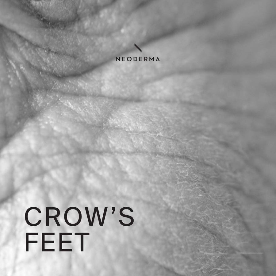 Crow’s Feet