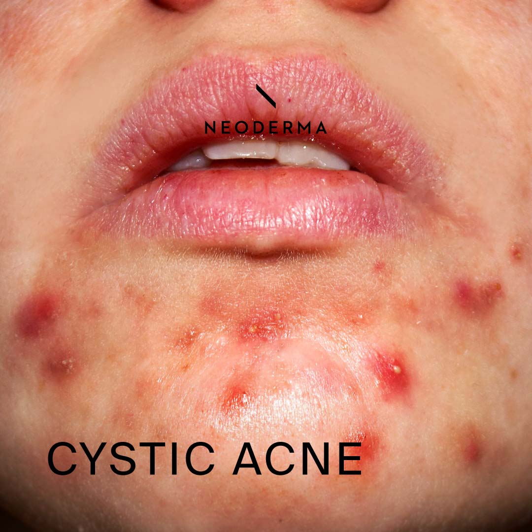 cystic chin acne
