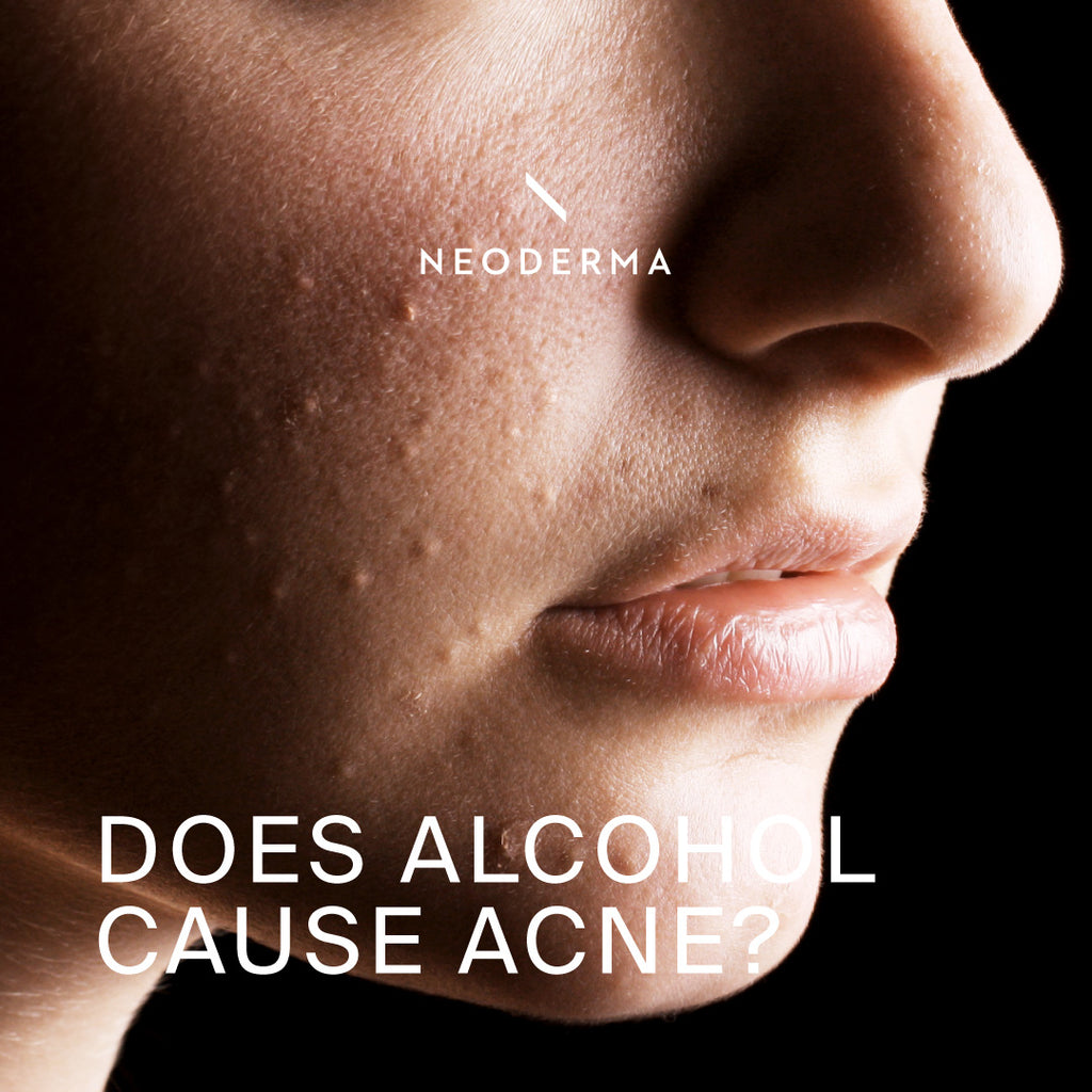 Does Alcohol Cause Acne?
