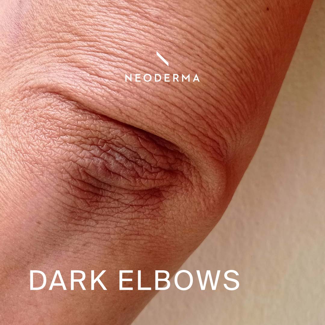 Dark Elbows