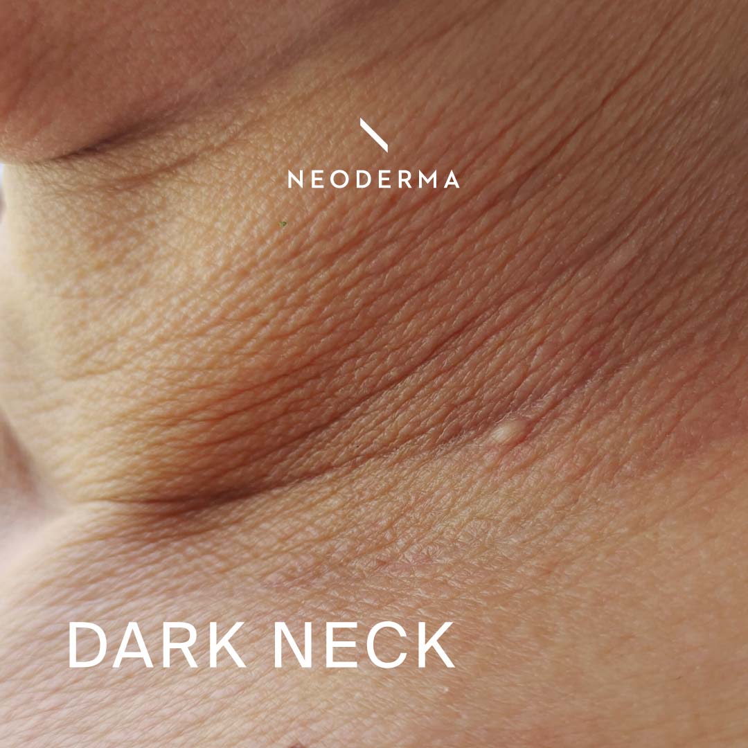 Dark Neck