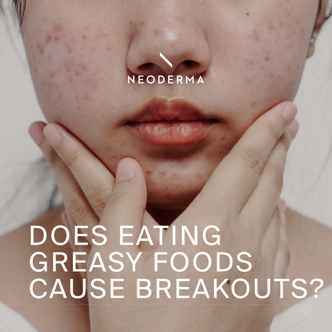 Greasyasses Does Eating Greasy Foods Cause Breakouts? โ NEODERMA