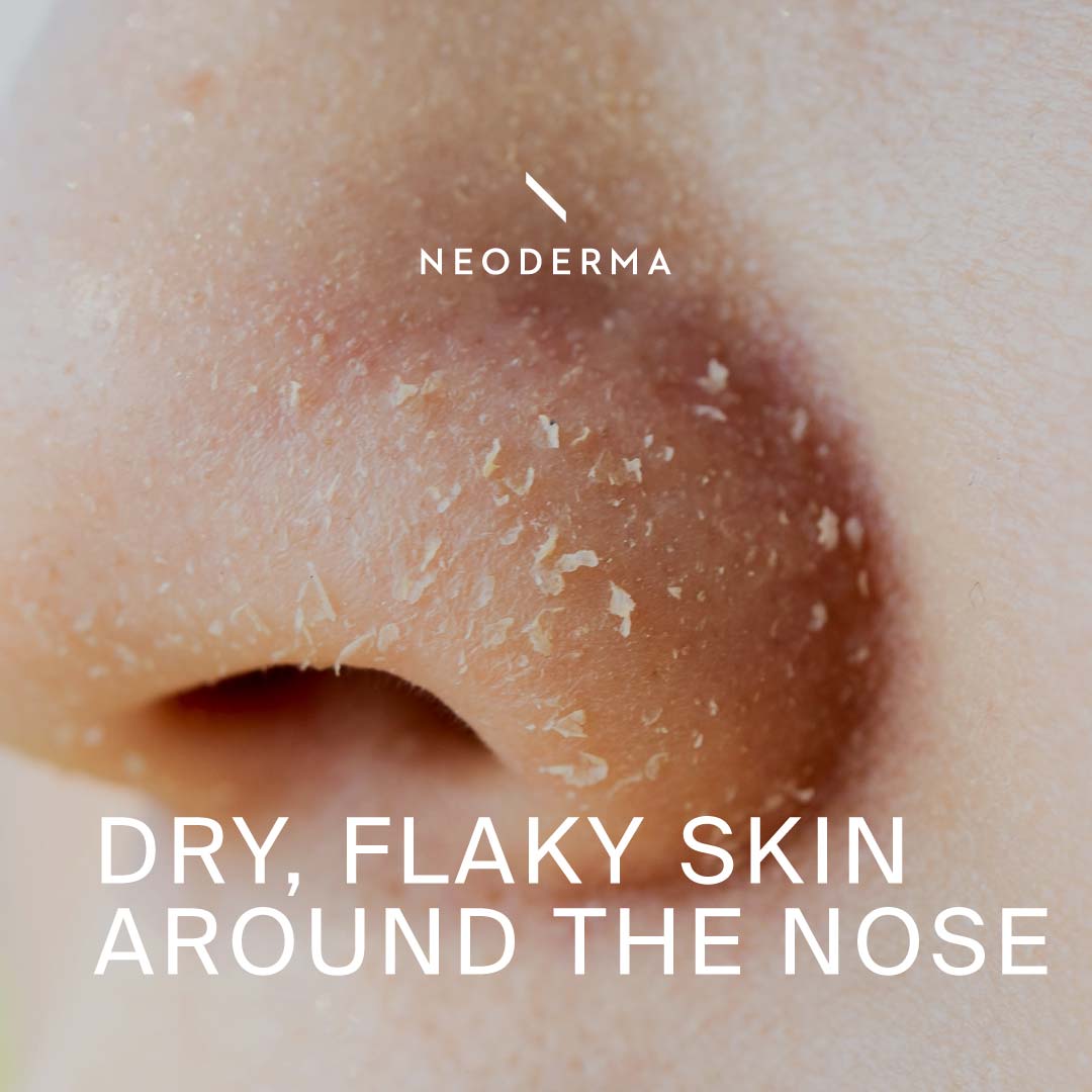 Dry, Flaky Skin Around The Nose