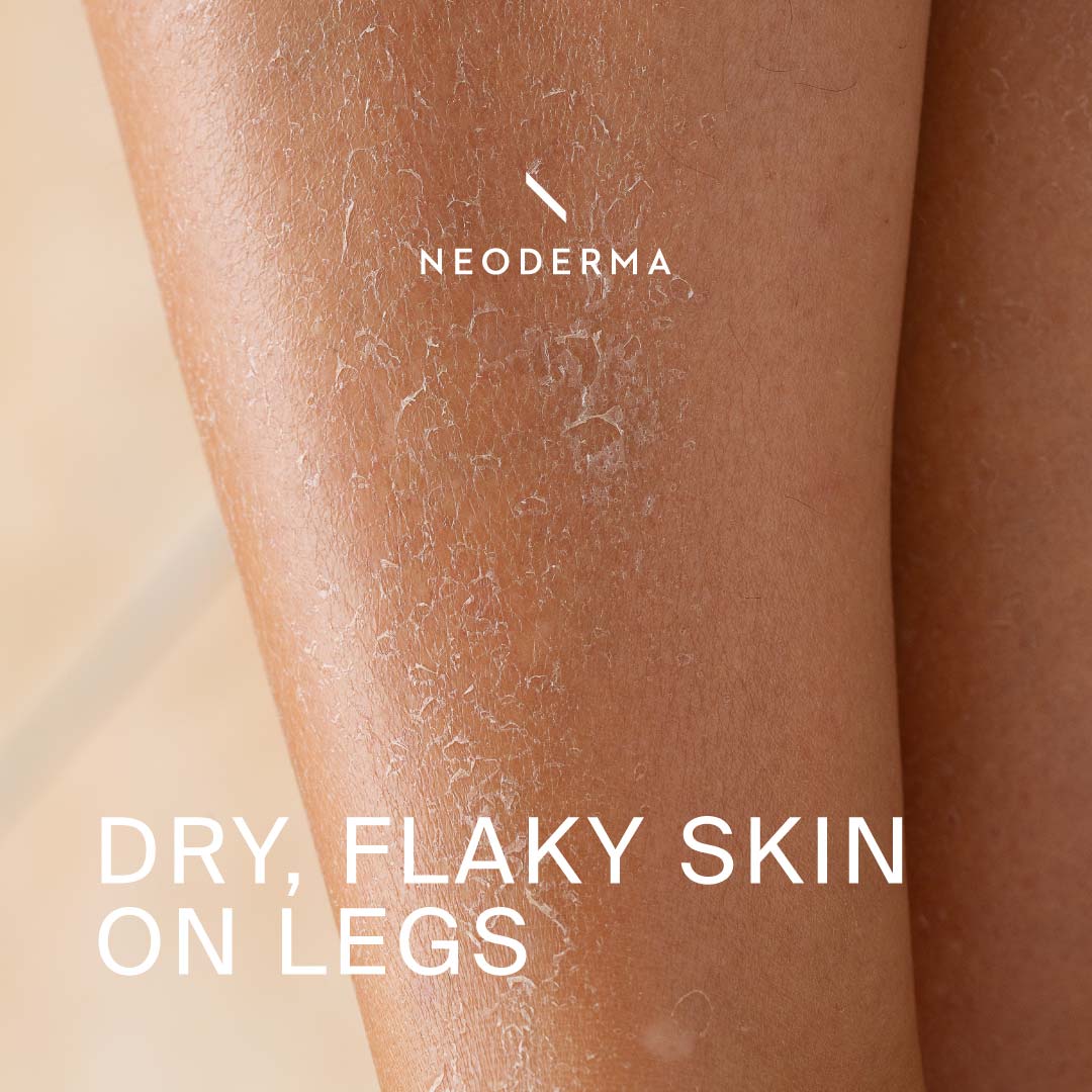 Dry, Flaky Skin on Legs