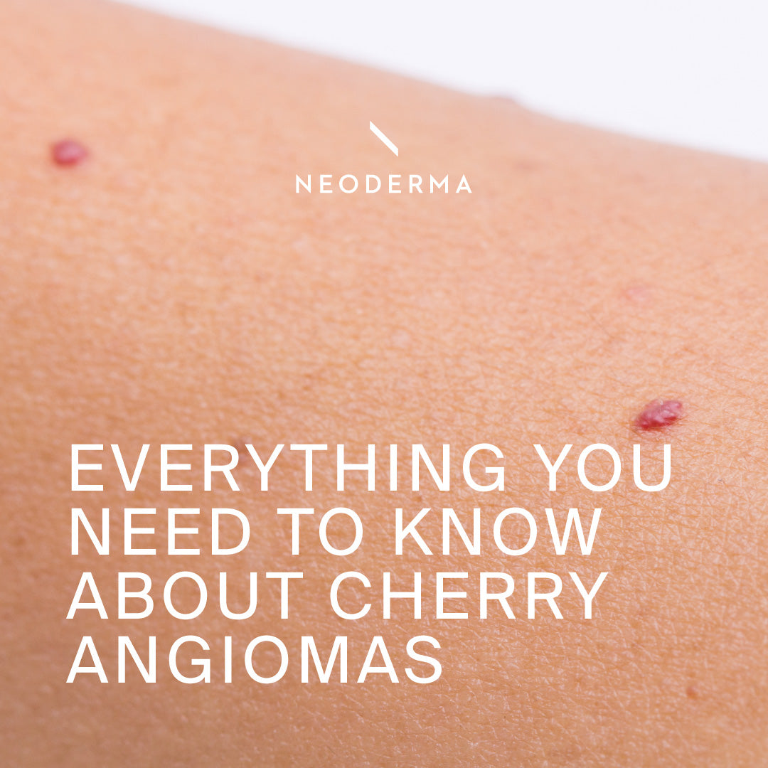 Everything You Need to Know About Cherry Angiomas