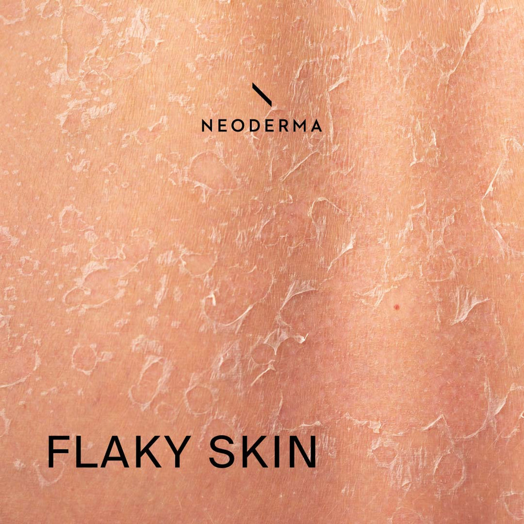 Flaky Skin