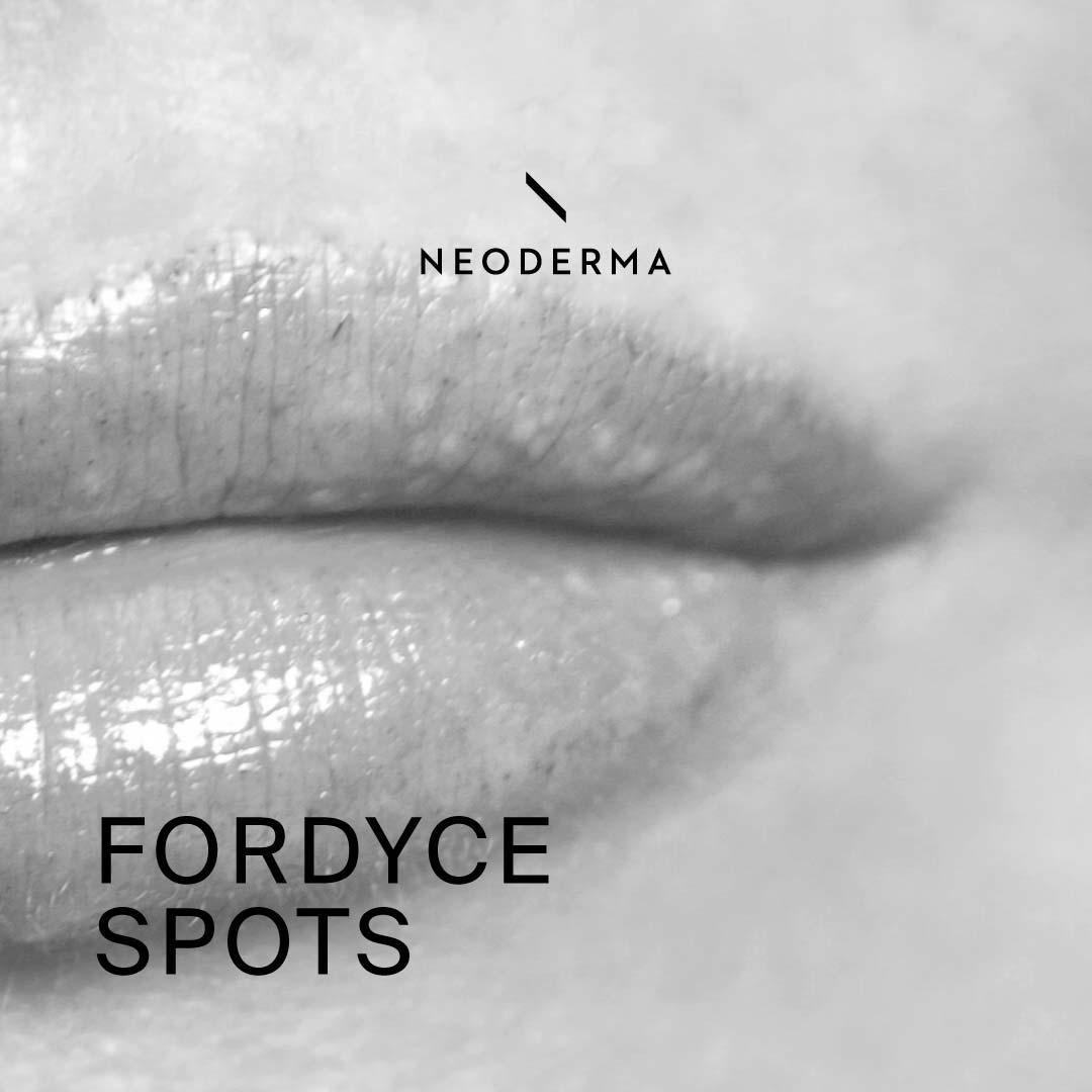 Fordyce Spots