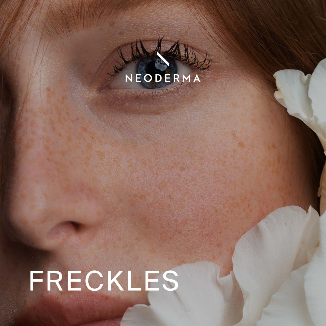 Freckles