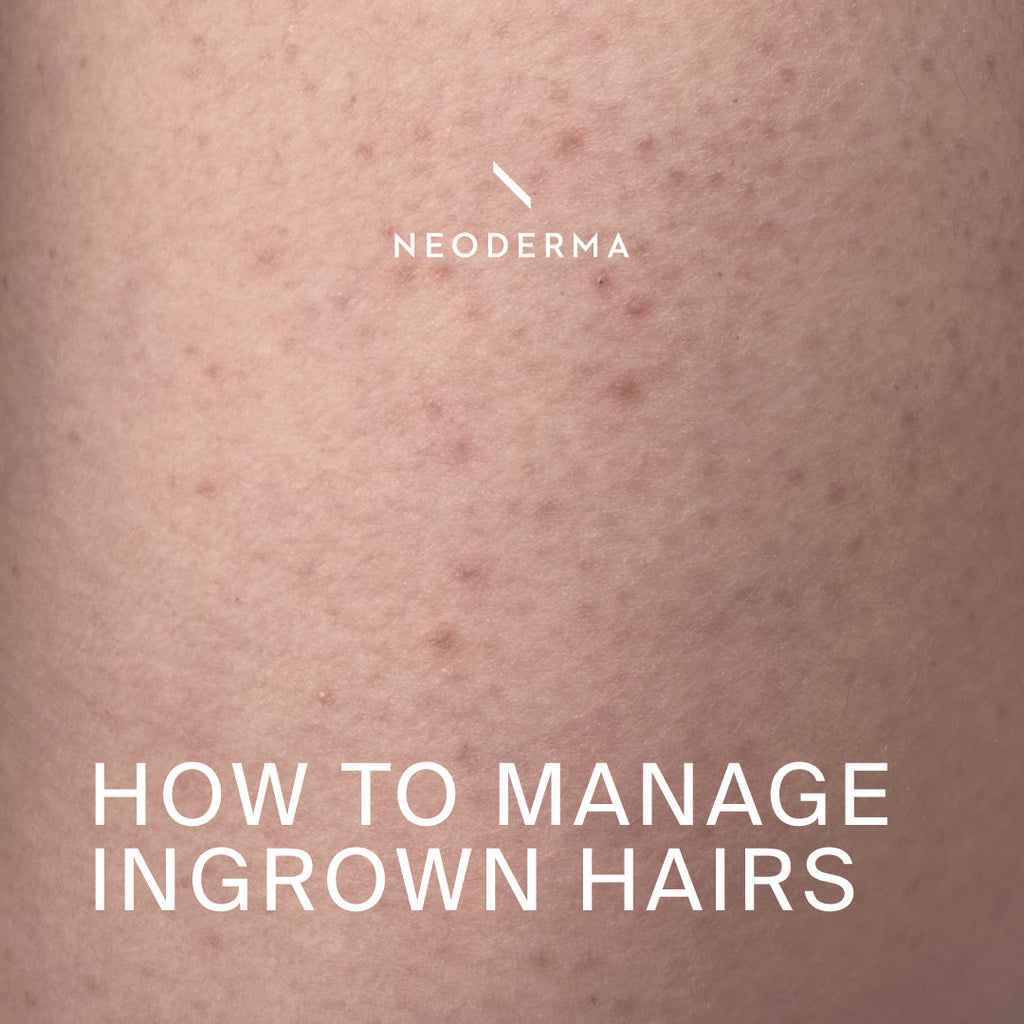 How to Manage Ingrown Hairs