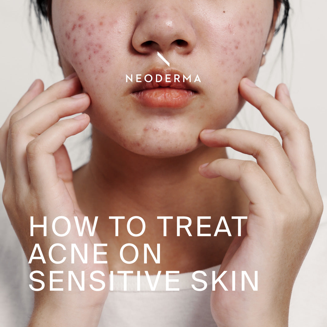 How to treat Acne on Sensitive Skin