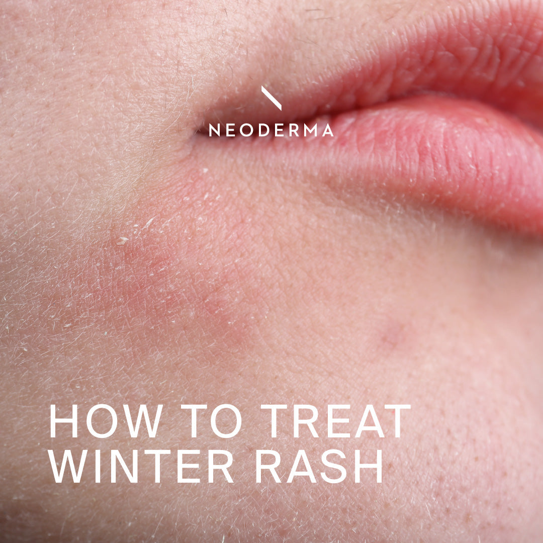 How to Treat Winter Rash