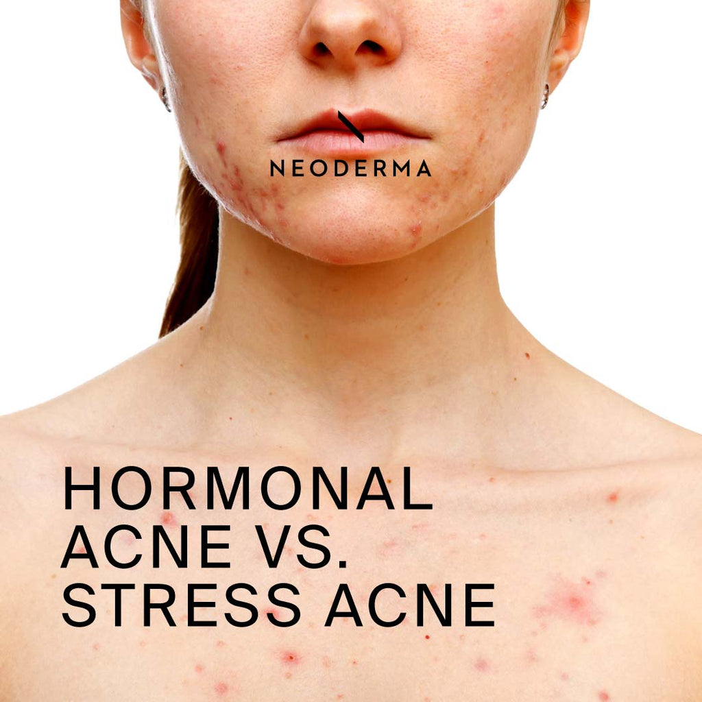 Hormonal Acne Vs. Stress Acne