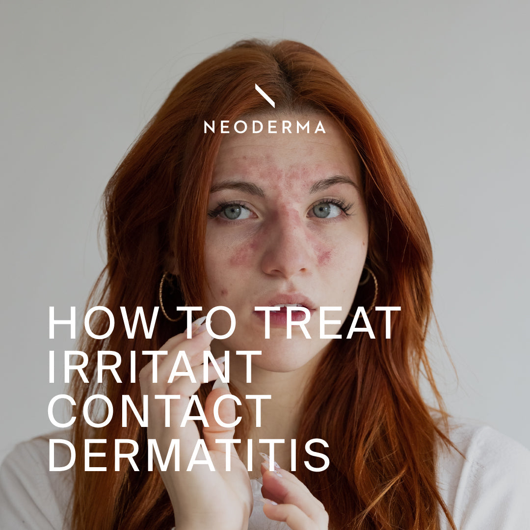 How to Treat Irritant Contact Dermatitis