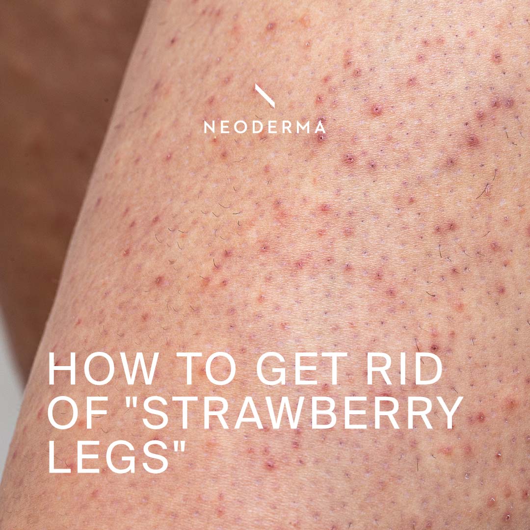 How to Get Rid of ''Strawberry Legs'' – NEODERMA