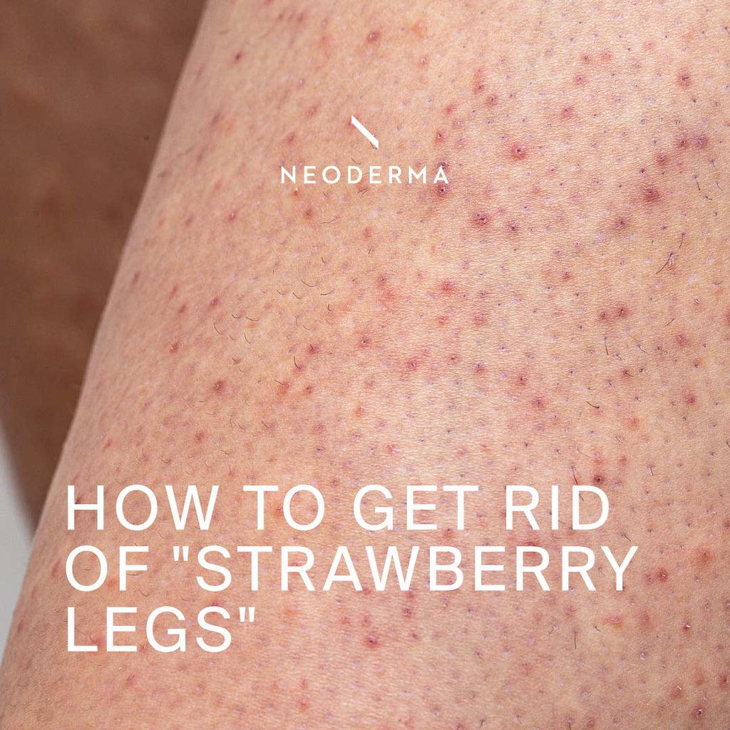 How to Get Rid of ''Strawberry Legs''