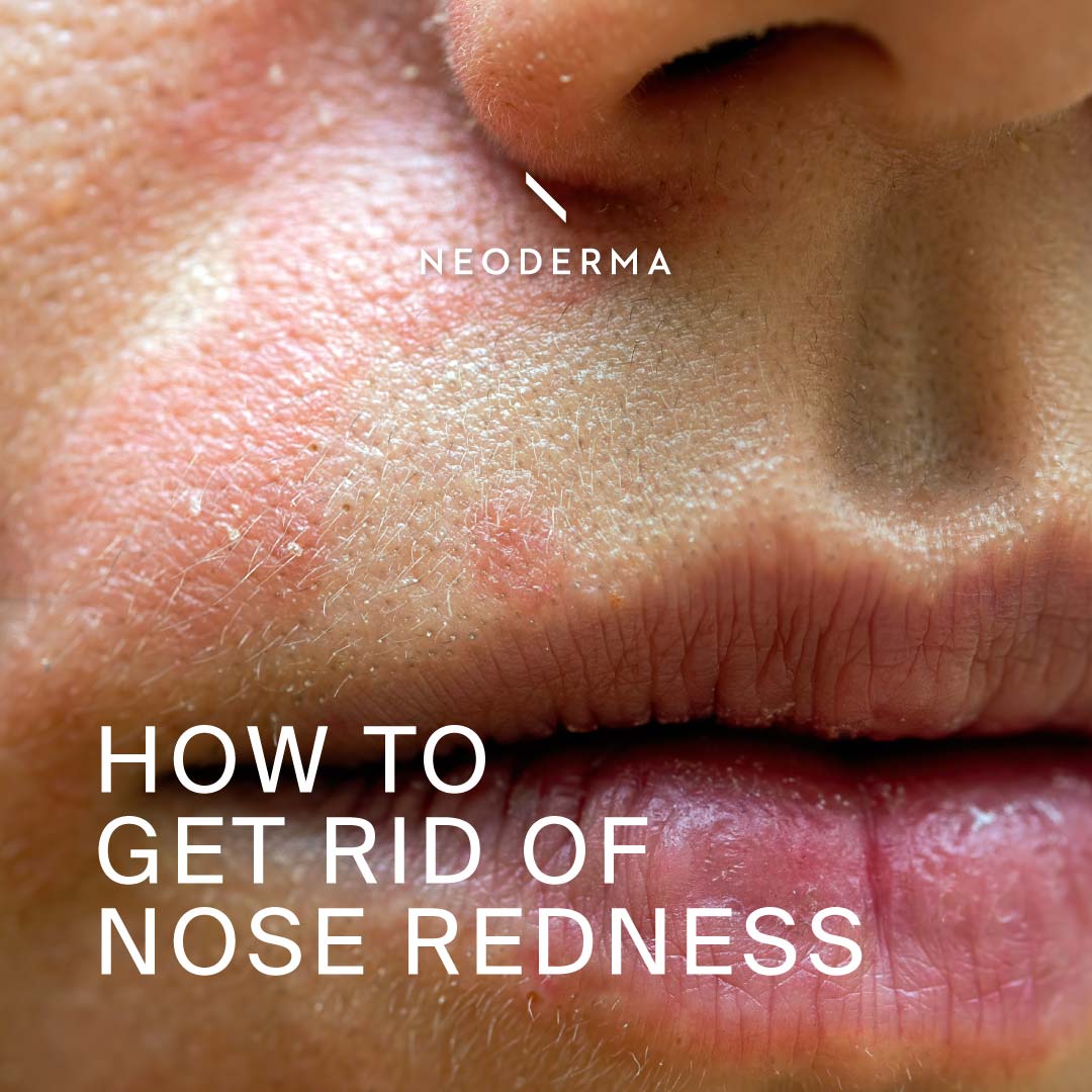 How to Get Rid of Nose Redness