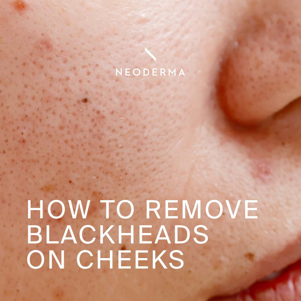 How to Remove Blackheads on Cheeks