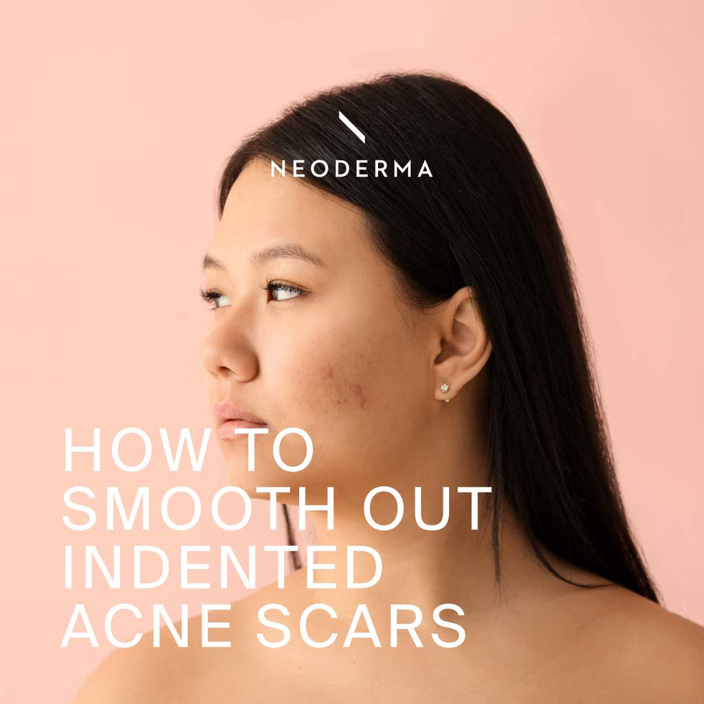 How to Smooth Out Indented Acne Scars