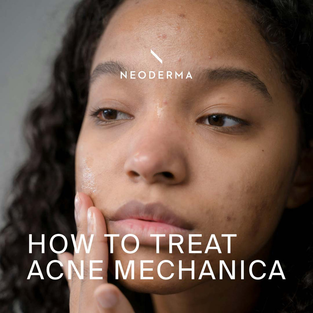 How to Treat Acne Mechanica